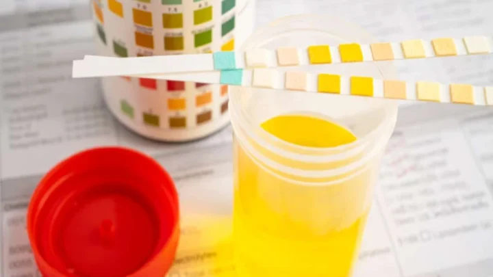 Urine : quand s'inquiéter de sa couleur ?